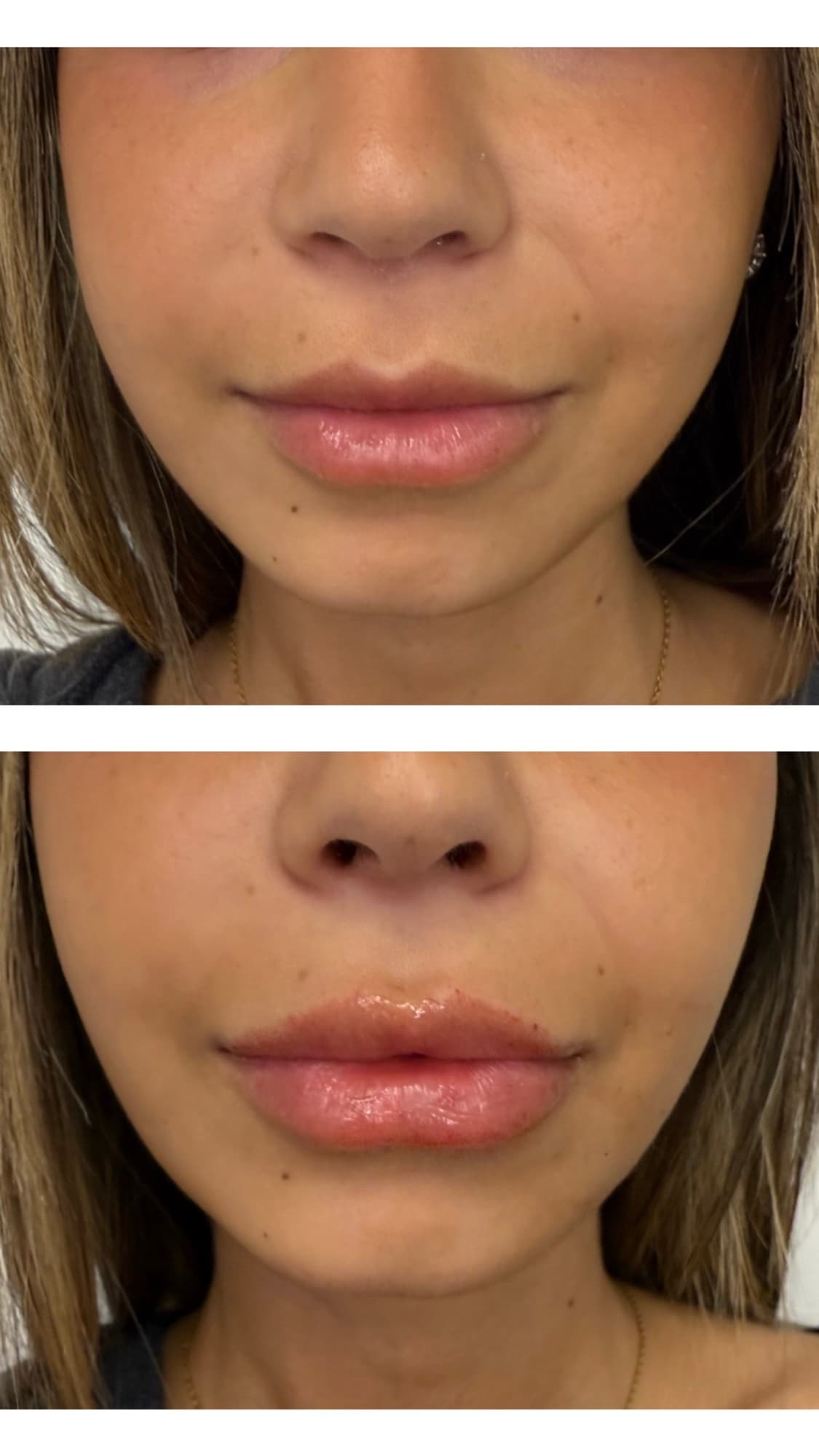 Before and after lip filler treatment