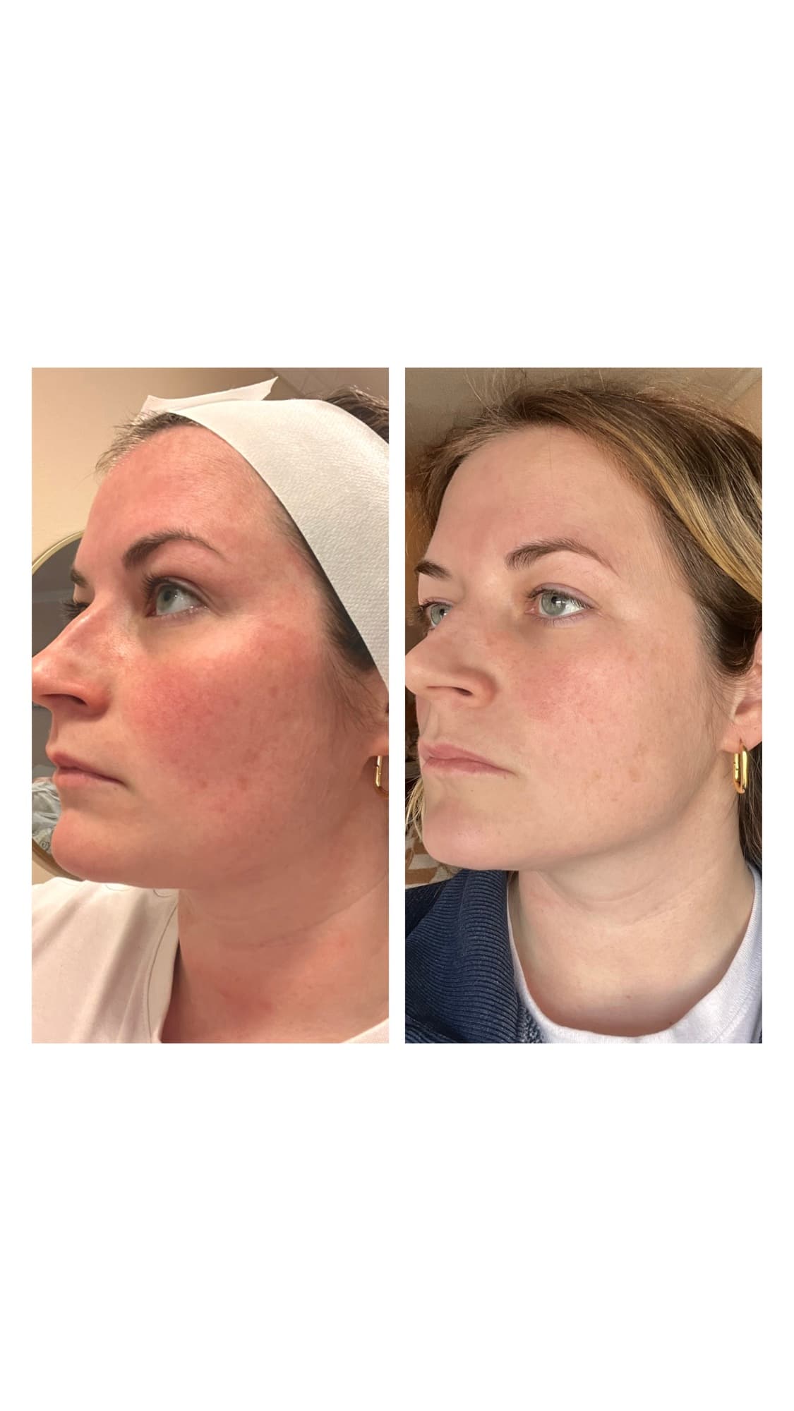 Before and after SkinPen microneedling treatment, profile view