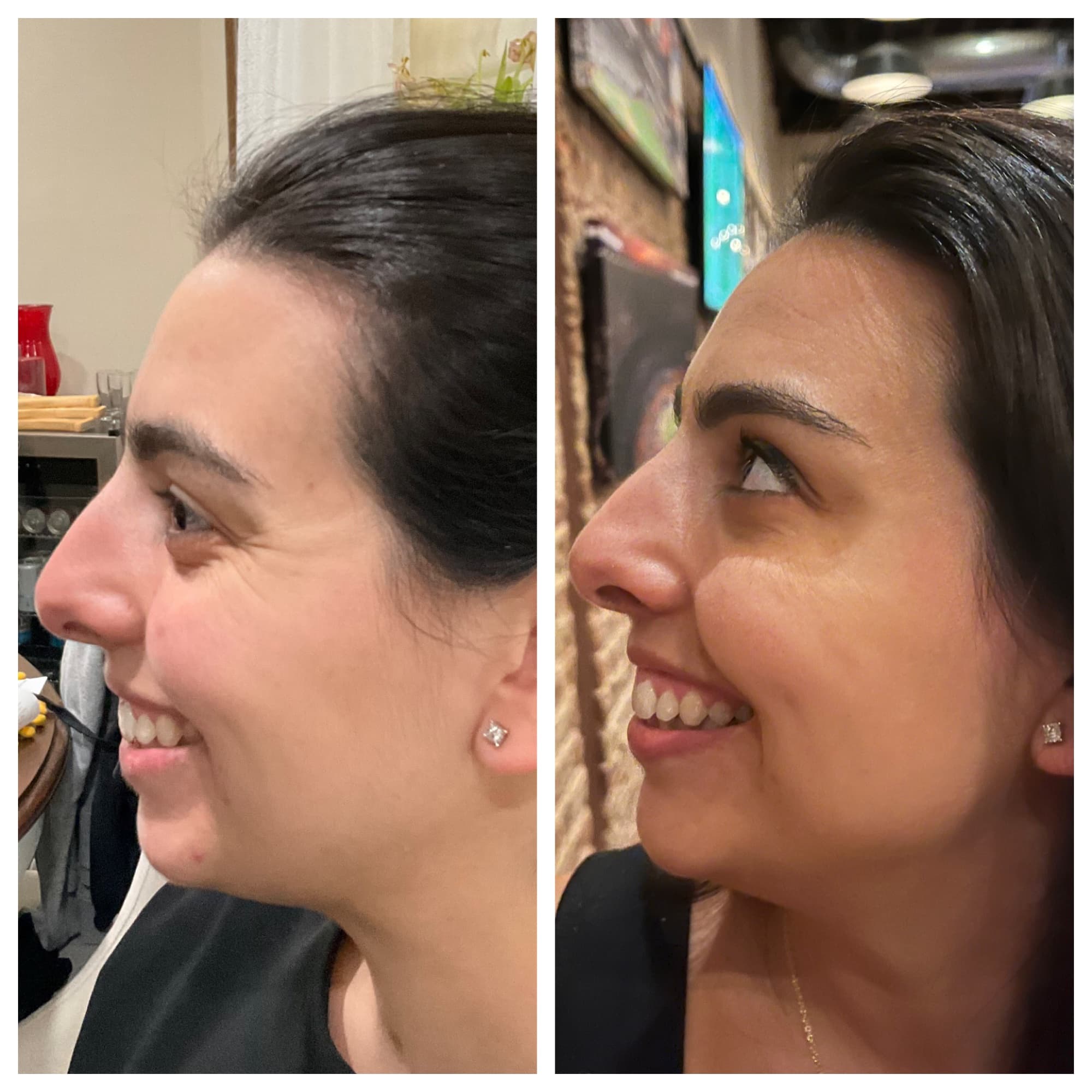 Before and after wrinkle relaxer treatment, profile view