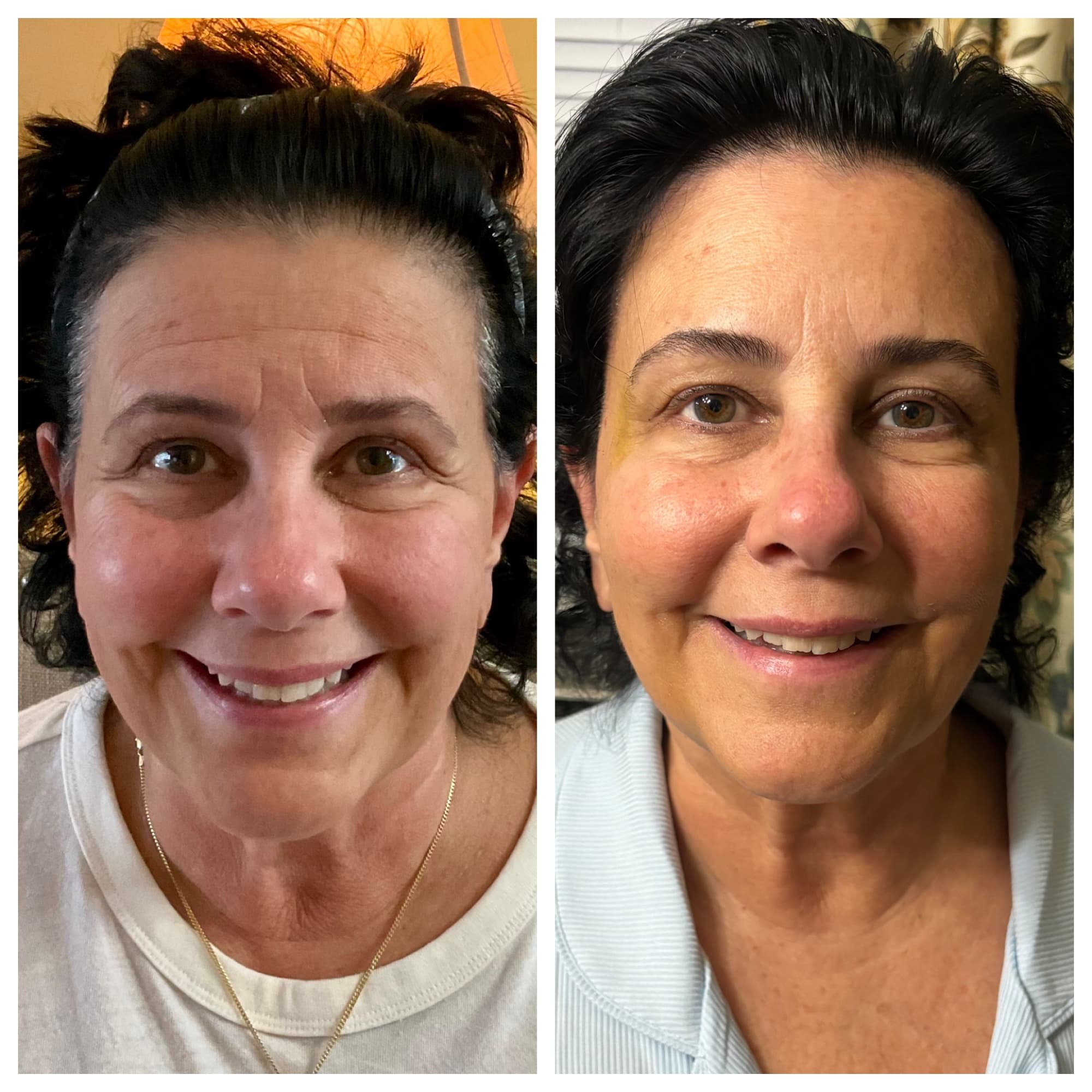 Before and after wrinkle relaxer treatment